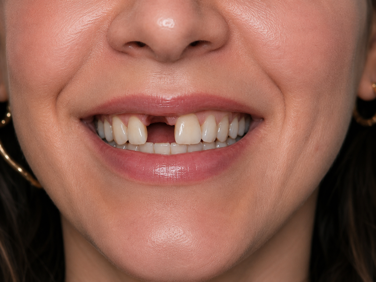 After dental implant — complete natural smile