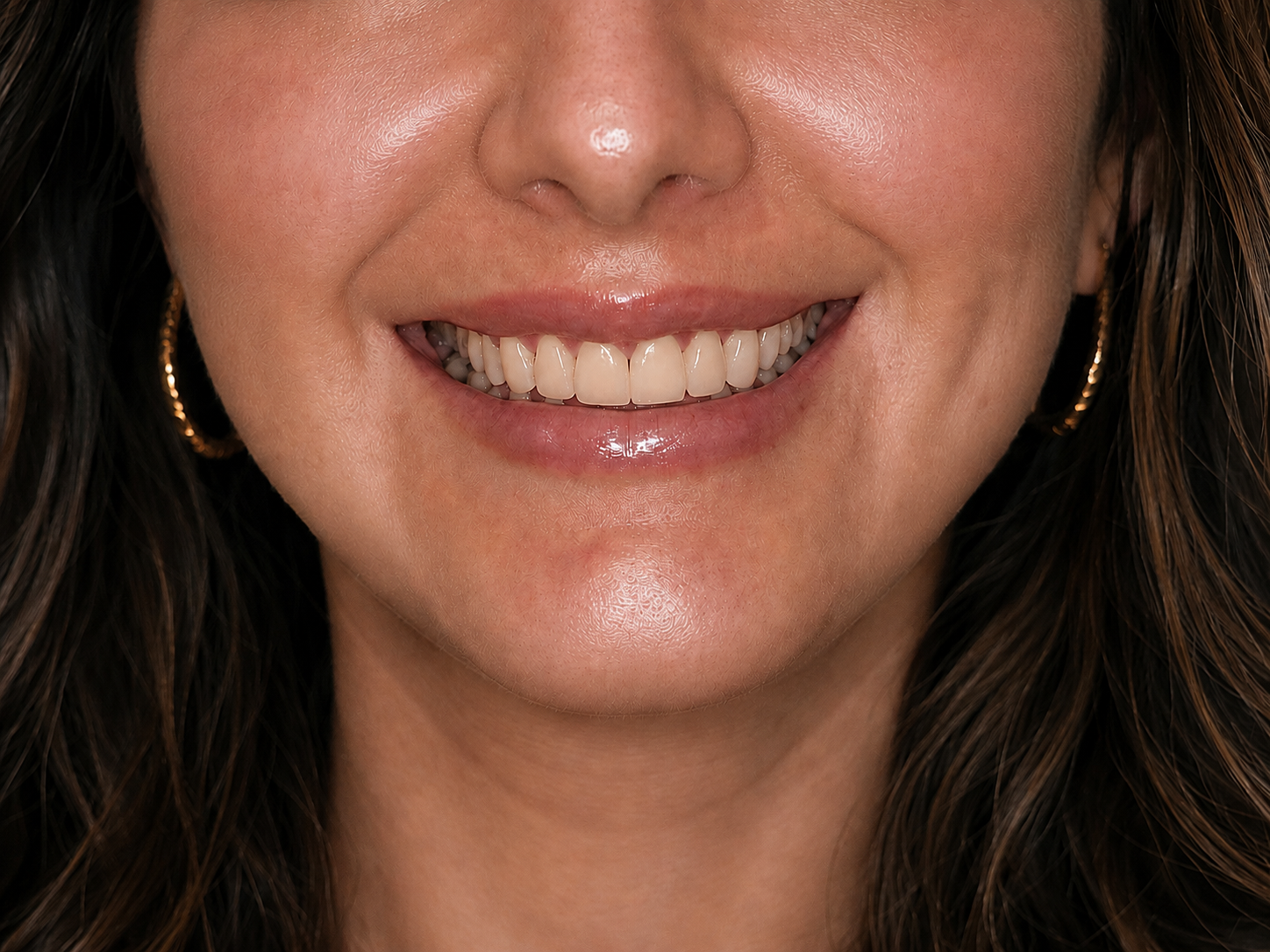 After porcelain veneers — natural bright smile