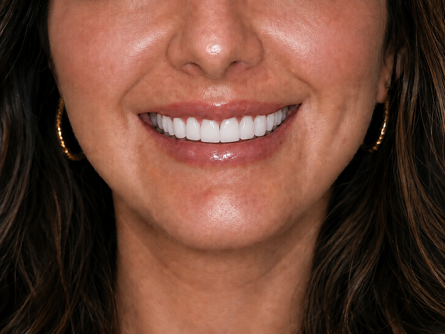 Before porcelain veneers